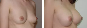 Πριν & Μετά - Αυξηση Μαστων