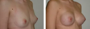 Πριν & Μετά - Αυξηση Μαστων