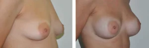 Πριν & Μετά - Αυξηση Μαστων